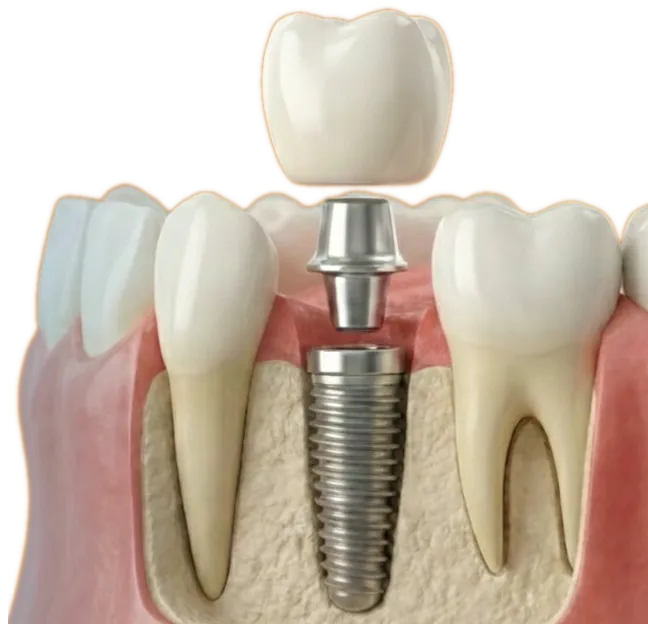 Implantes Dentales y Cirugía